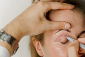 Brow Lift Sacramento & Granite Bay CA