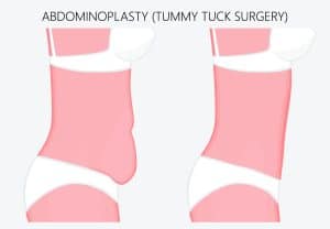 Tummy Tuck Sacramento, CA