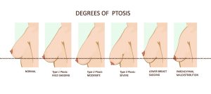 What is the Pencil Pinch Test for Breast? - Dr. Scott Green