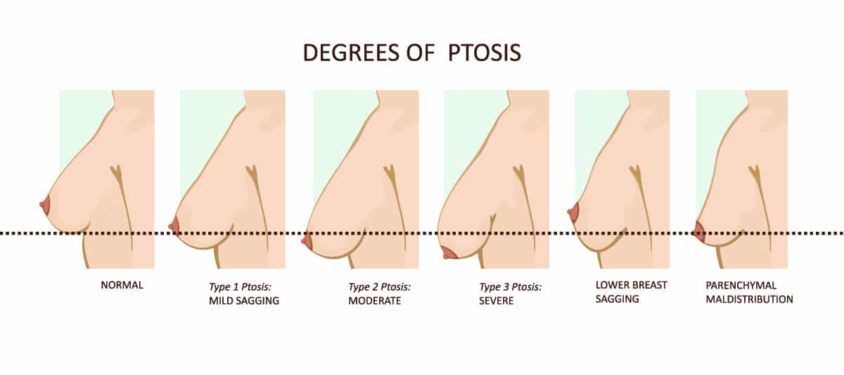 What is the Pencil Pinch Test for Breast? - Dr. Scott Green