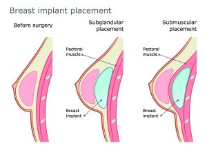 Breast Augmentation Sacramento Ca