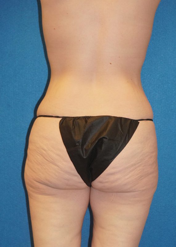 abdominoplasty 71g