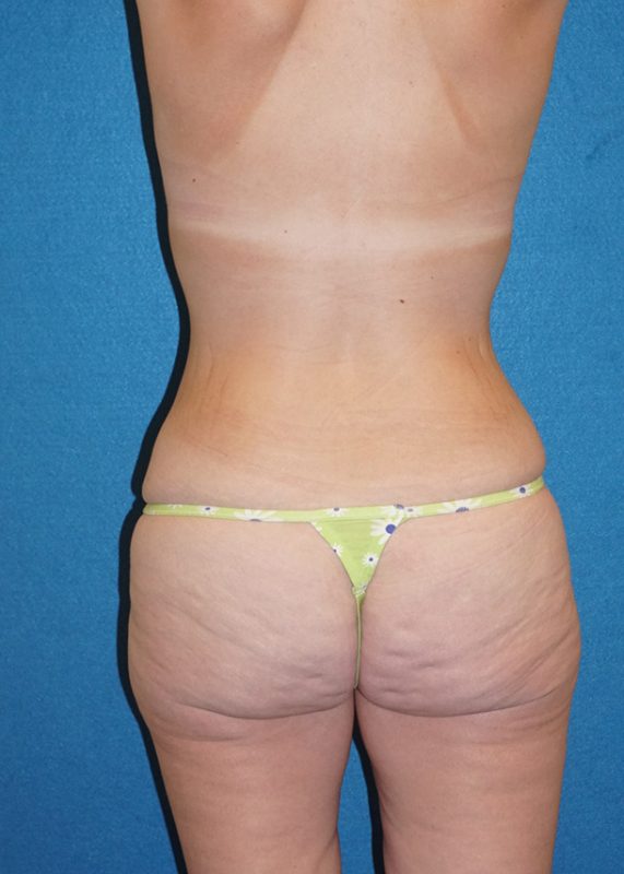 abdominoplasty 71h