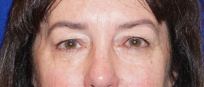 brow lift 22a