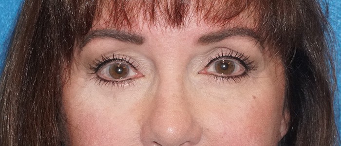 brow lift 22b