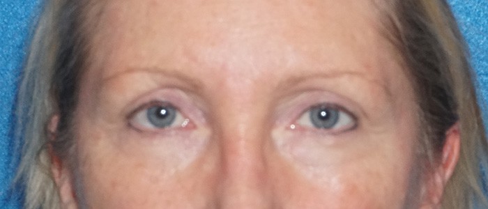 brow lift 23a