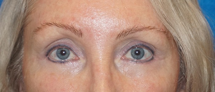 brow lift 23b