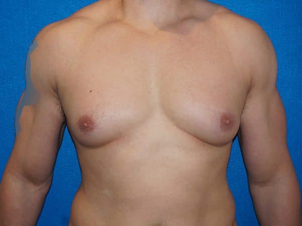 gynecomastia 4a