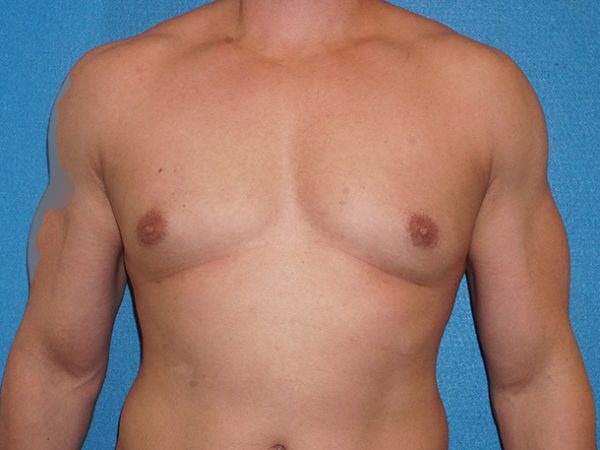 gynecomastia 4b