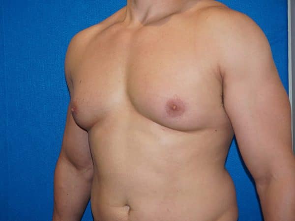 gynecomastia 4c