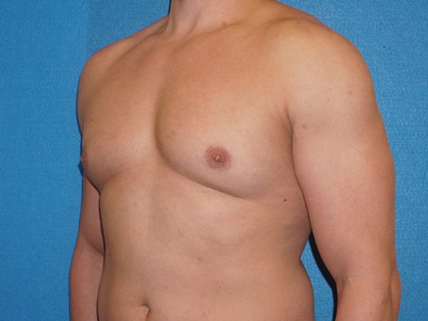 gynecomastia 4d