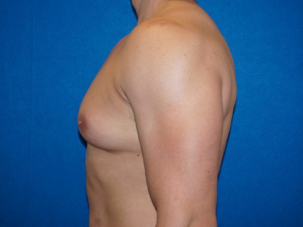 gynecomastia 4e