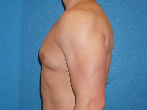 gynecomastia 4f