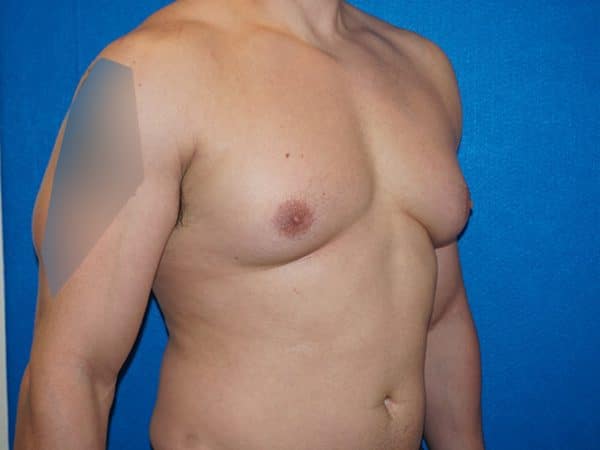 gynecomastia 4g