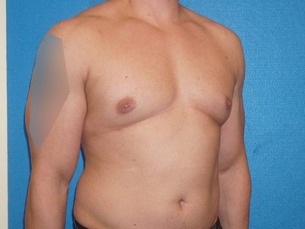 gynecomastia 4h