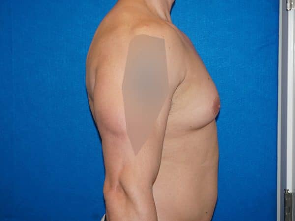 gynecomastia 4i