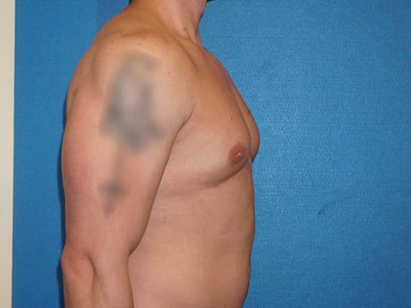 gynecomastia 4j 1