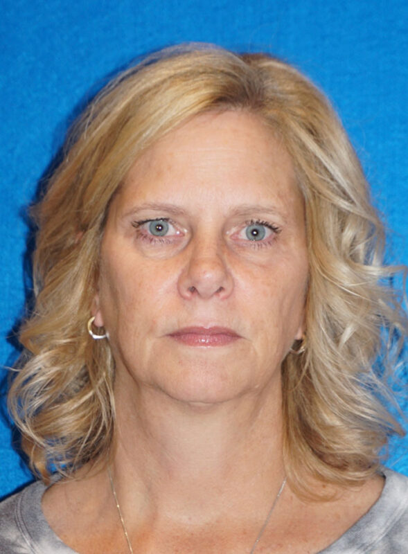 facelift patient92 a