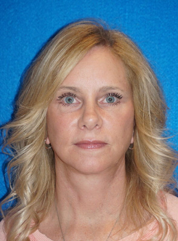 facelift patient92 b