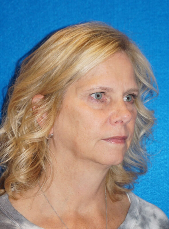 facelift patient92 c