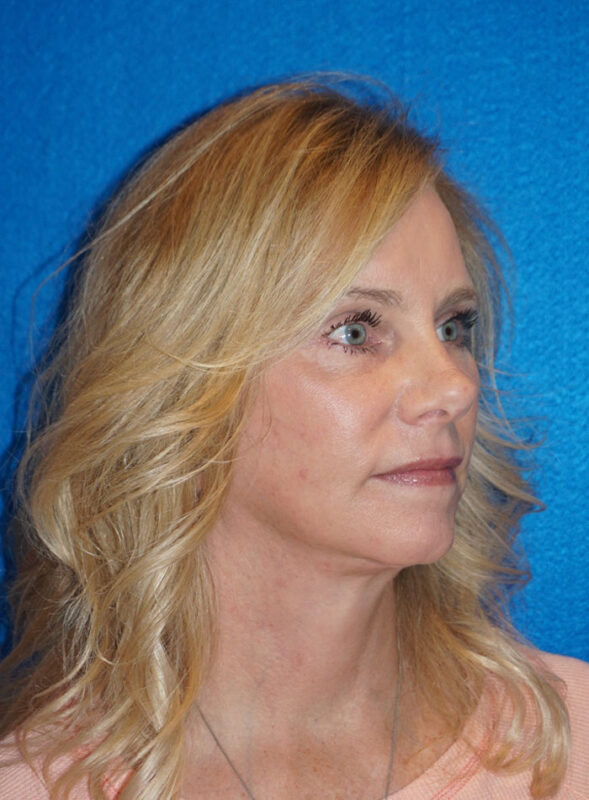 facelift patient92 d