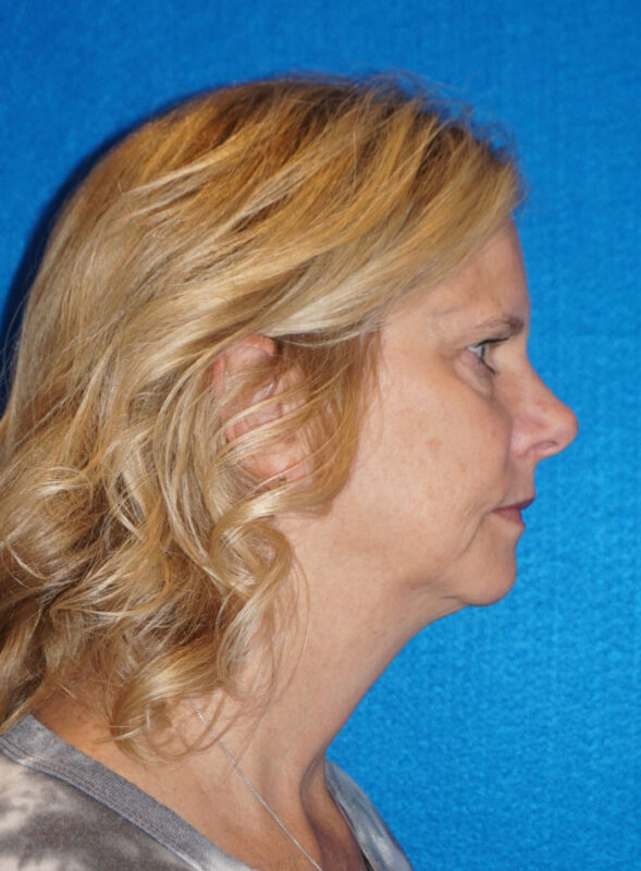 facelift patient92 e