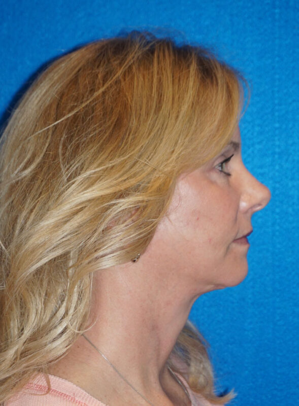 facelift patient92 f