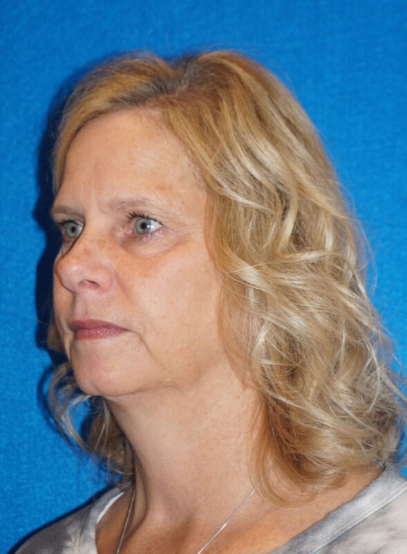 facelift patient92 g