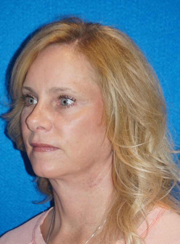 facelift patient92 h