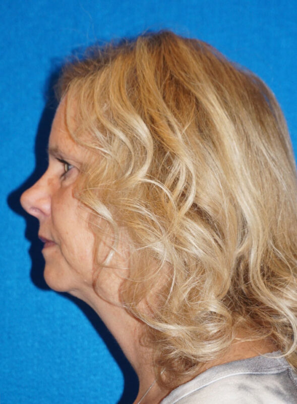 facelift patient92 i