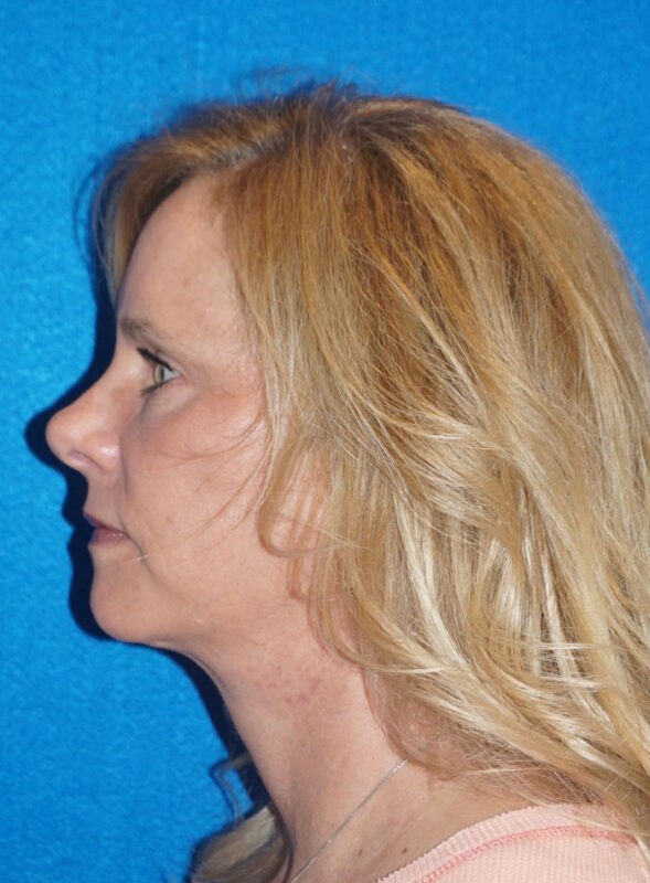 facelift patient92 j