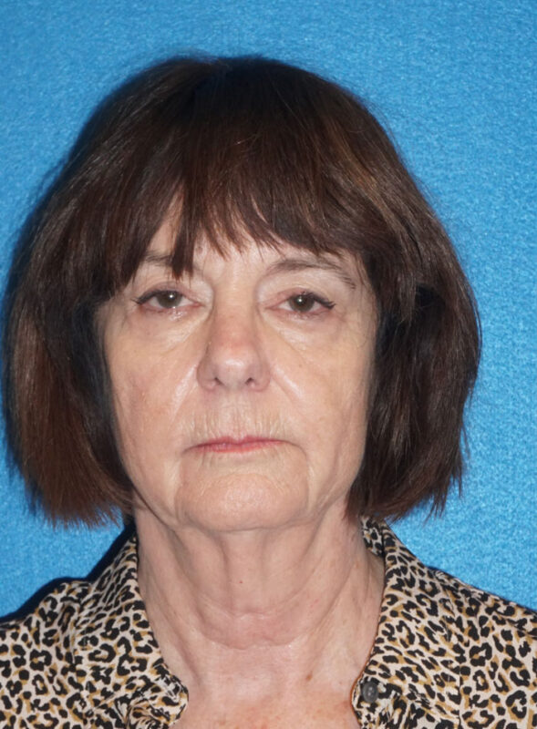 facelift patient95 a