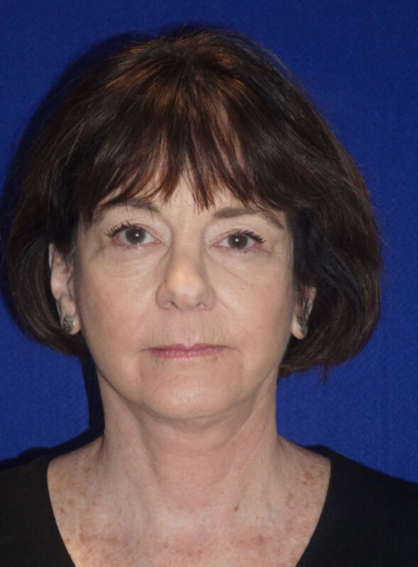 facelift patient95 b