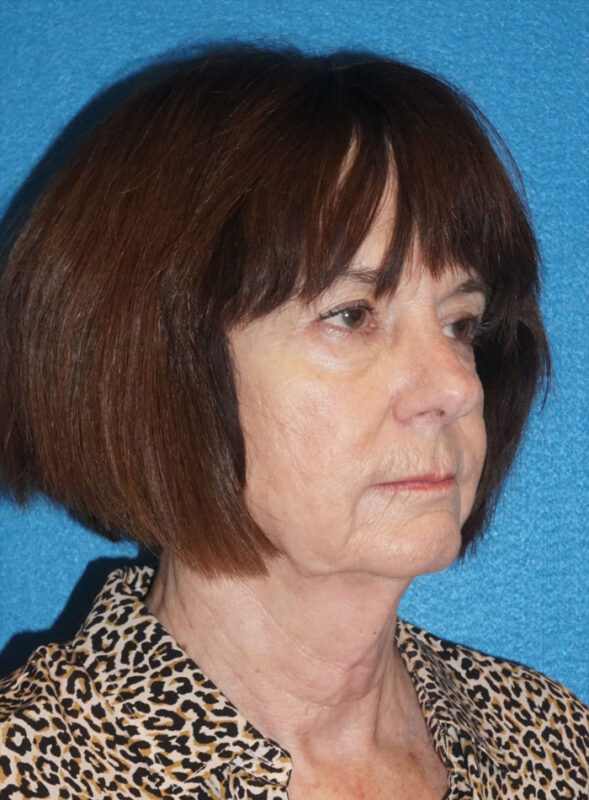 facelift patient95 c