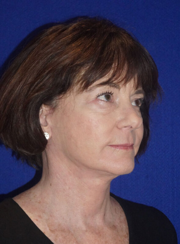 facelift patient95 d