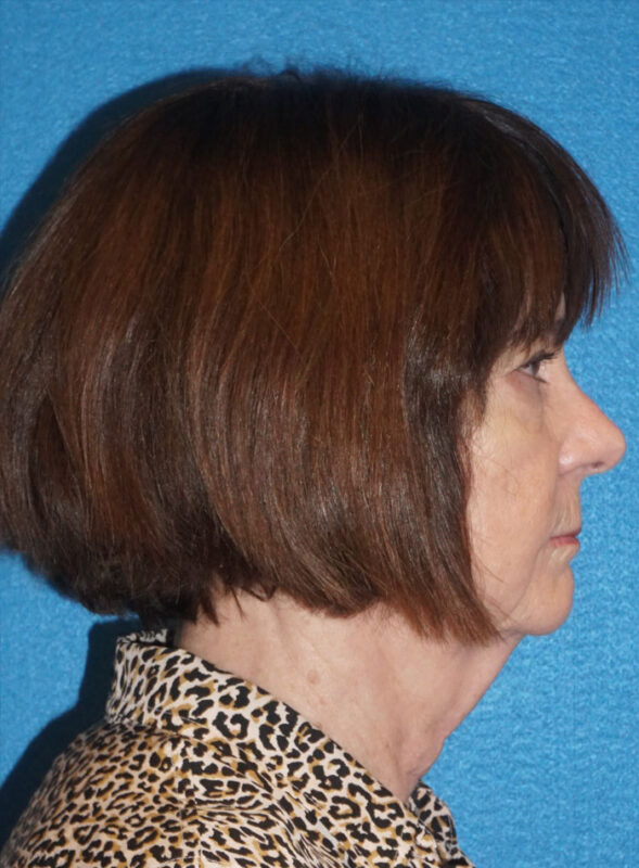 facelift patient95 e