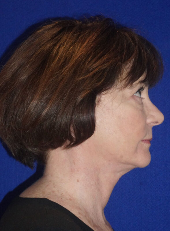 facelift patient95 f