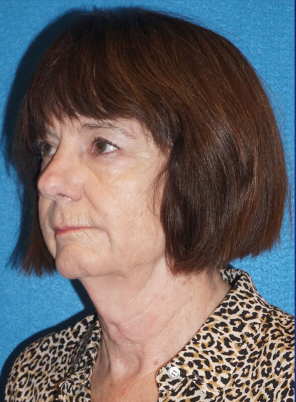 facelift patient95 g