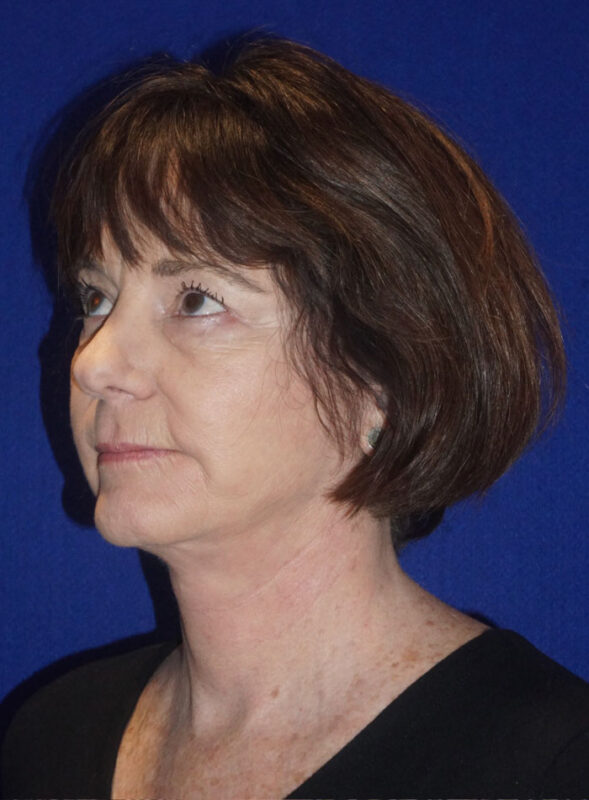 facelift patient95 h