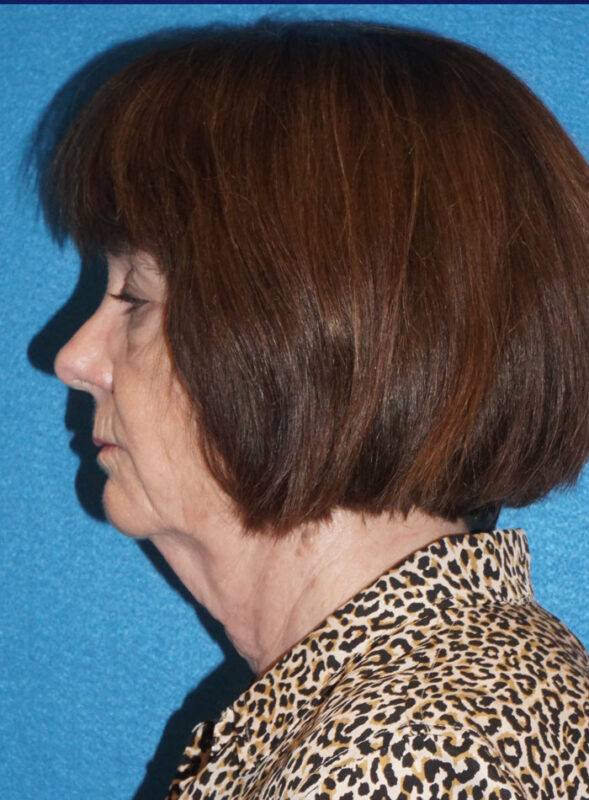 facelift patient95 i