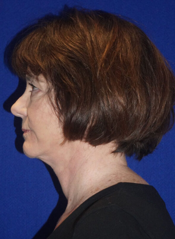 facelift patient95 j