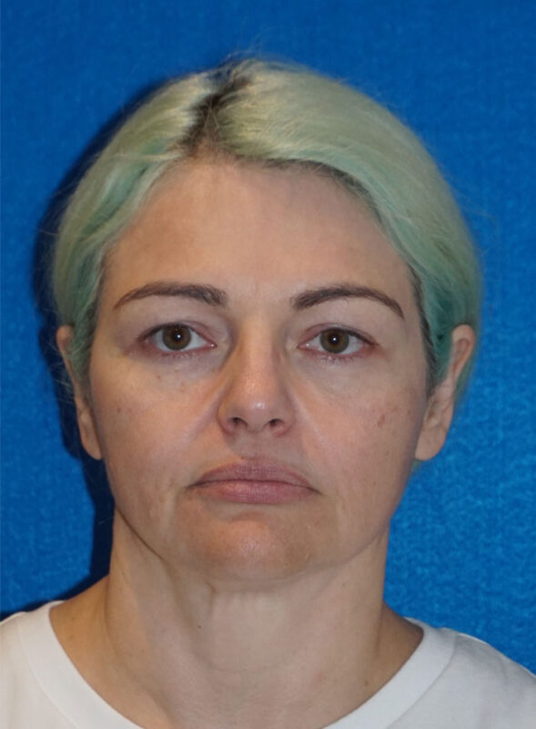 facelift patient96 a