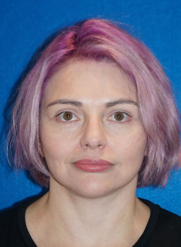 facelift patient96 b