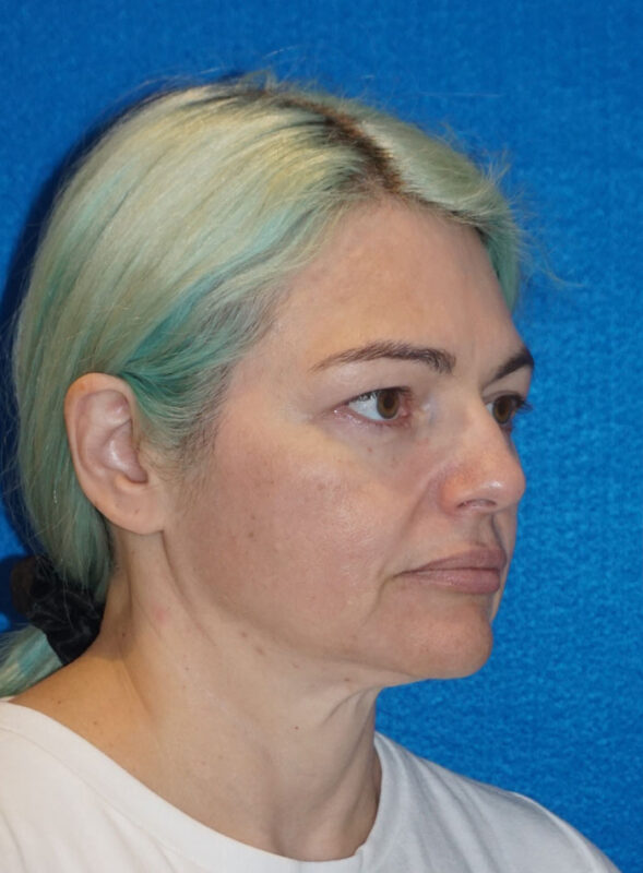 facelift patient96 c