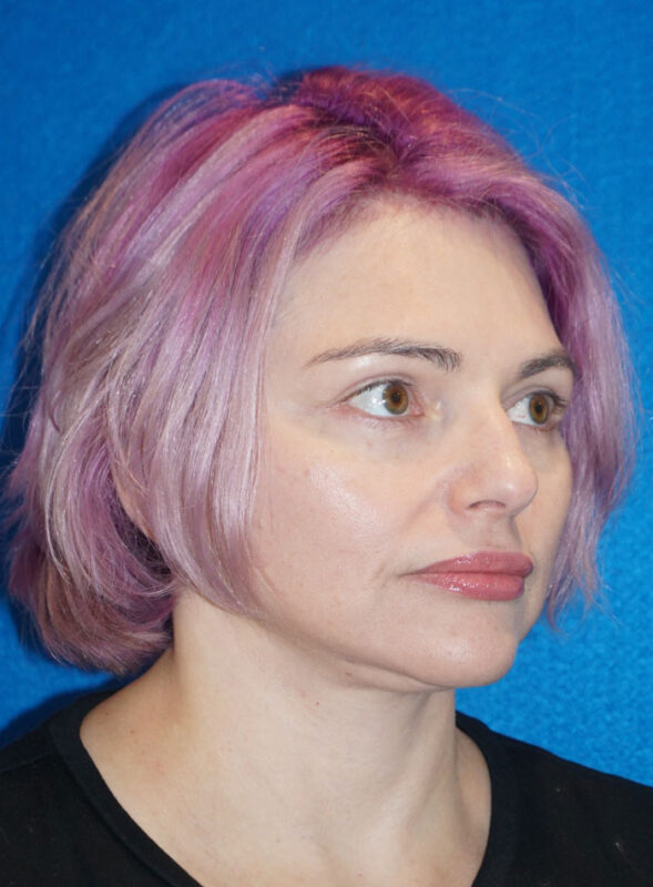 facelift patient96 d