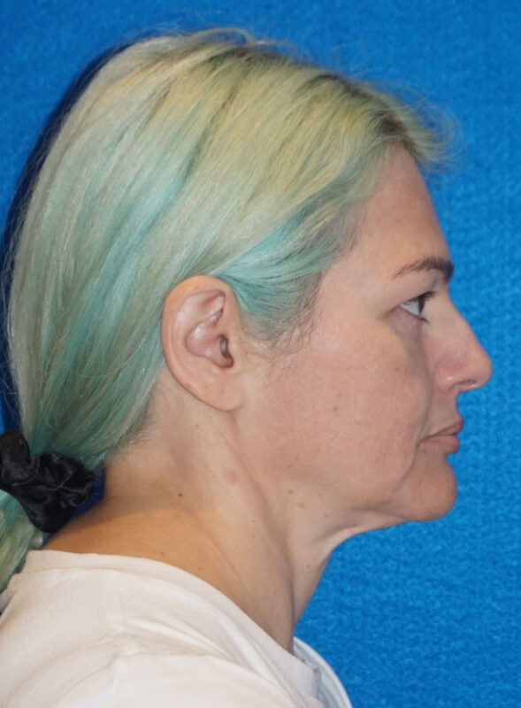 facelift patient96 e