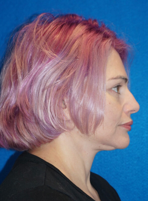 facelift patient96 f