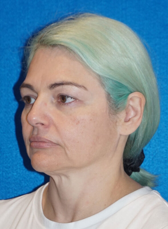 facelift patient96 g