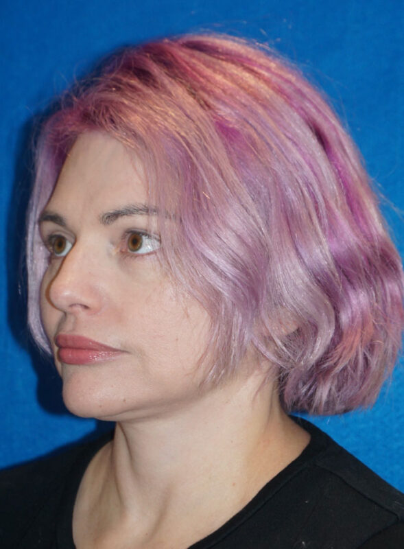 facelift patient96 h