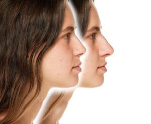 Rhinoplasty Granite Bay